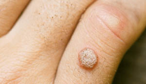 wart removal columbia sc