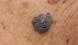 mole removal