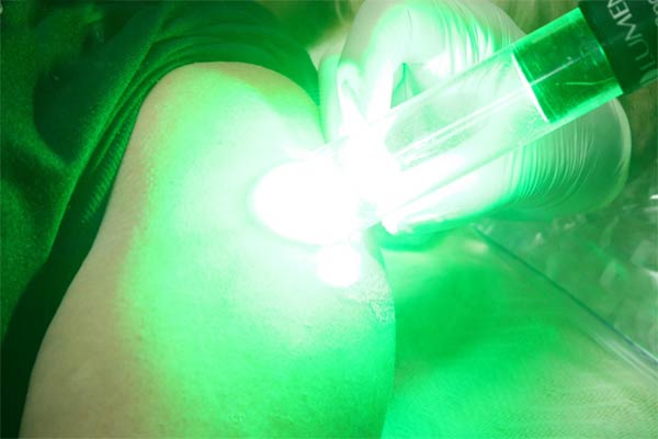 laser-tattoo-removal-600w